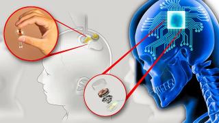 Se caută oameni pentru implant de cip în creier; Neuralink acceptă înscrieri de la voluntari