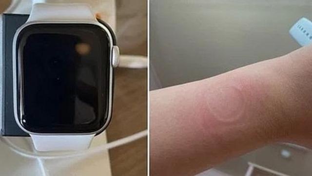 <b>Apple Watch SE suferă de supraîncălzire, conform unor utilizatori din Coreea de Sud; Caţiva au avut urme roșii pe piele</b>Ca la fiecare debut de produs, e inevitabil să apară şi unele probleme. Apple Watch SE face pocinogul de această dată, utilizatori din Coreea de Sud postând pe Reddit că unităţile lor se supraîncălzesc